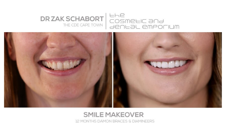 Dr Wim de Beer | Dr Zak | Smile Makeover | Cape Town Dentist