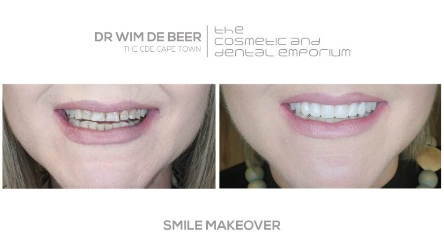 Dr Wim de Beer | Dr Zak | Smile Makeover | Cape Town Dentist