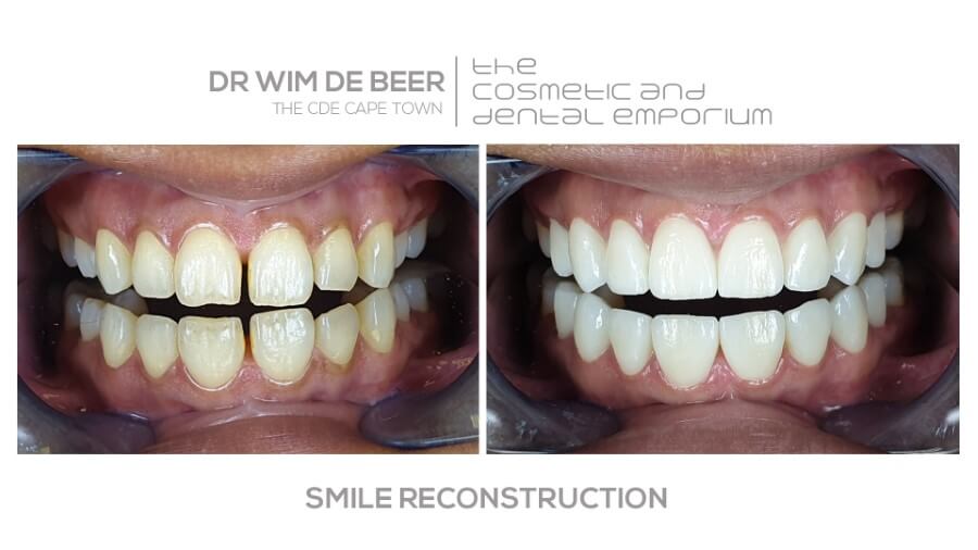 Dr Wim De Beer Dr Zak Smile Makeover Cape Town Dentist