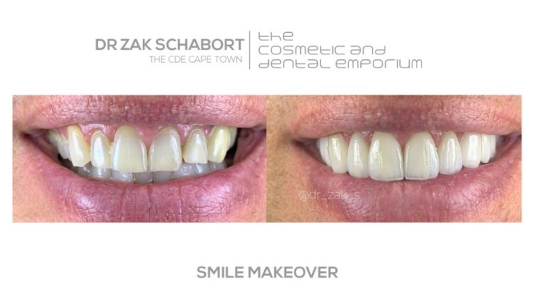 Dental Before and After | Smile Makeover | Cape Town Dentist