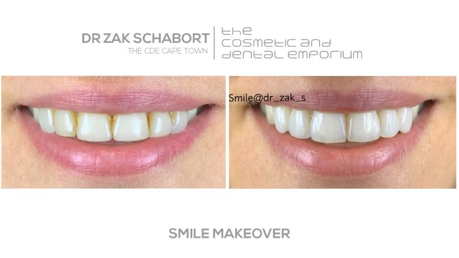 Dr Zak Smile Makeover - Cape Town Dentist - 021 418 2668