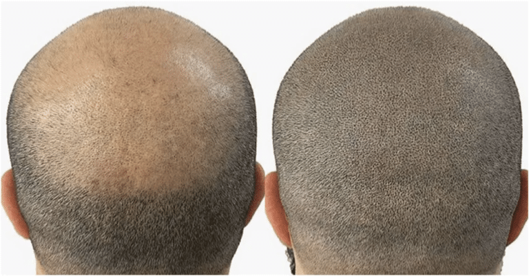 Scalp Micropigmentation (SMP)