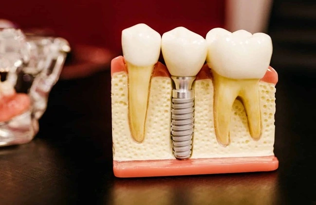 Root Canal